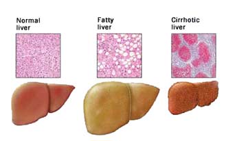 Fatty Liver Disease – Liver Basics